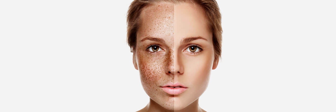 Pigmentation Treatment in Dubai